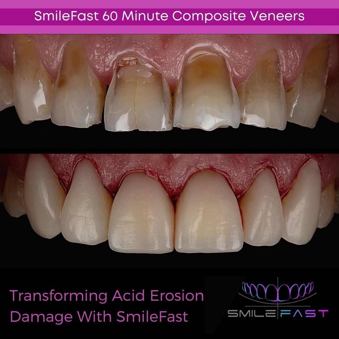 Smilefast Composite Veneers