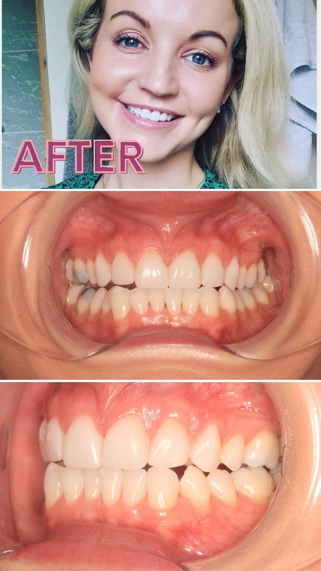 Before and after a smile makeover with Smile Fast