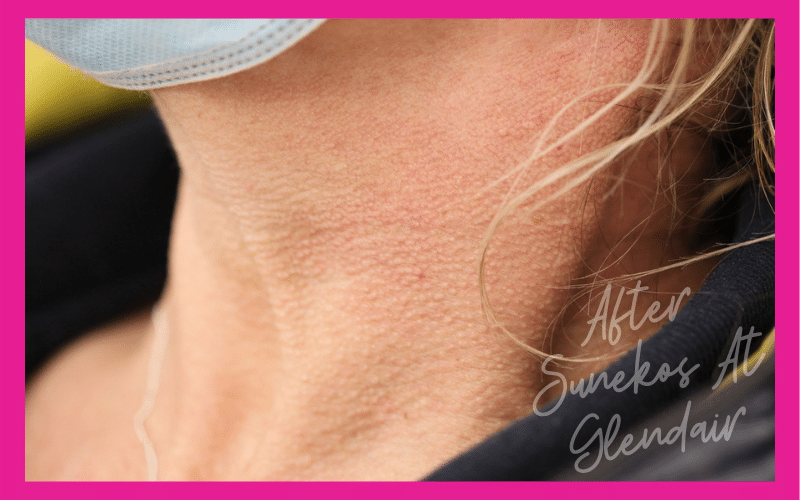 Glendair Dental Sunekos Glendair Dental Sunekos