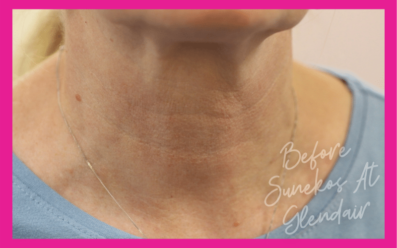 Glendair Dental Sunekos Glendair Dental Sunekos