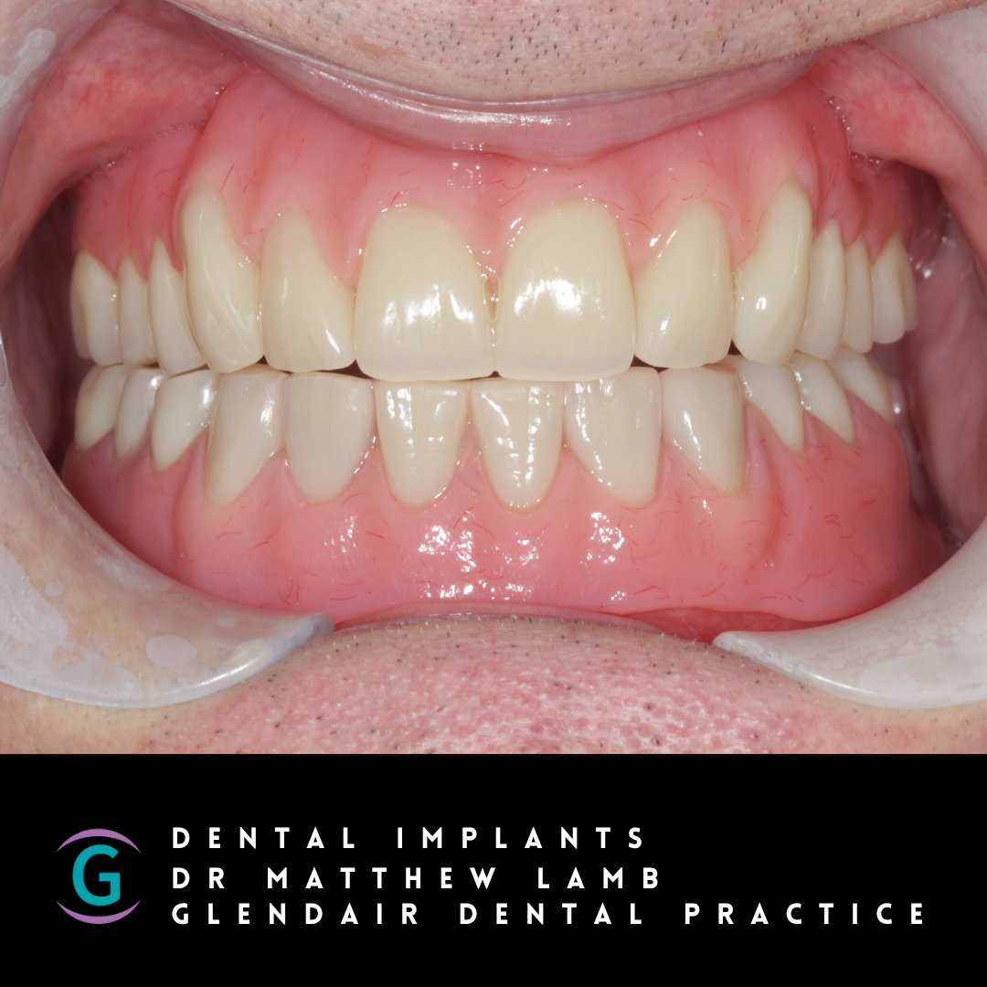 Glendair Dental Dental Implants before and after dental implant treatment Glendair Dental