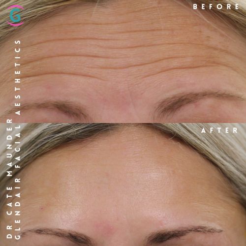 Glendair Dental Face And Beauty Treatments Before And After Beauty Treatment
